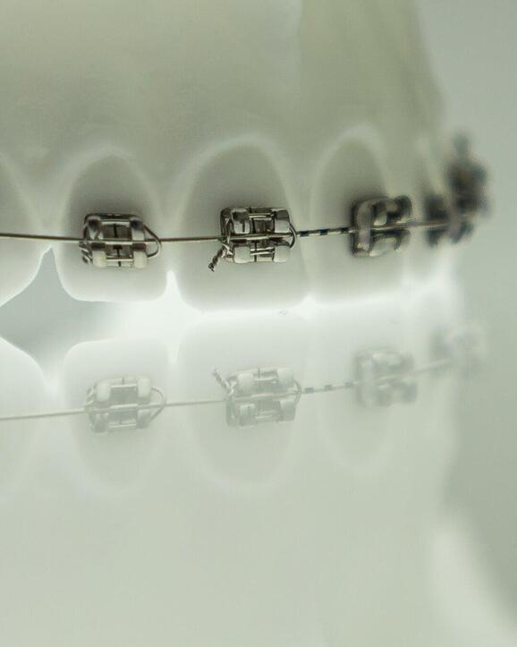 Self-ligating braces that align teeth efficiently using advanced brackets without elastic ties.